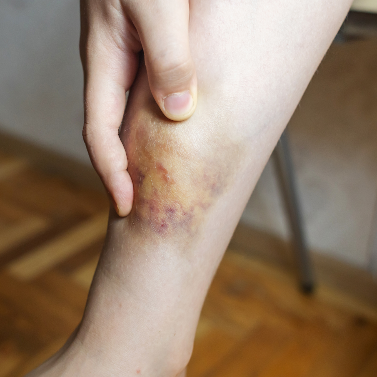 Une main déposé sur une jambe ayant un bleu